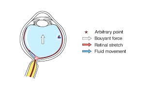 Mechanism of Retinal Displacement Following Pars Plana Vitrectomy [upl. by Lzeil]