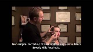 NonSurgical Under Eye Hollow Treatment  Beverly Hills Aesthetics [upl. by Uot]