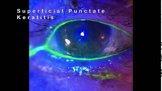 Superficial Punctate Keratitis SPK [upl. by Ingles897]