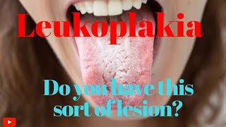 LEUKOPLAKIA Premalignant condition of oral cavity [upl. by Stanfill68]