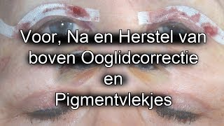 Review Boven Ooglidcorrectie en Ervaring Pigmentvlekjes verwijderen [upl. by Ahsinawt]