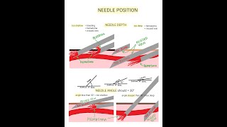 Venipuncture  How to Position a Needle [upl. by Yerffej]