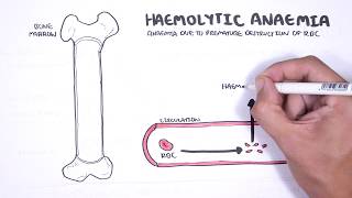 Haemolytic Anaemia  classification intravascular extravascular pathophysiology investigations [upl. by Hamal614]