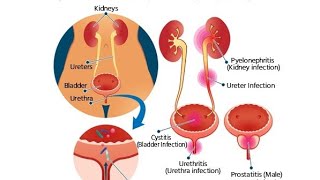 INFEKSIONET URINARE ESCHERICHIA COLIinfeksioneturinare escherihiacoli traktiurinarinfeksionet [upl. by Coleville]