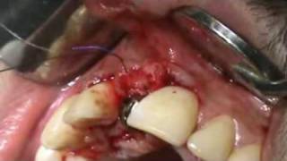 3i Implant placement in the aesthetic zoneafter EASY GRAFT socket preservation [upl. by Suivart]