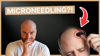 Microneedling gegen Haarausfall – Arzt klärt auf [upl. by Lynea863]