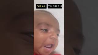 Treatment of Oral Thrush oralthrush treatment [upl. by Annayi]