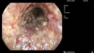 metastatic colorectal malignancy [upl. by Fielding]