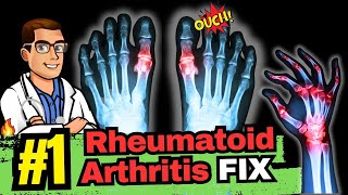 The Best Natural Treatment for Rheumatoid Arthritis [upl. by Ainoek106]