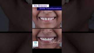 No Braces Teeth Gaps Closure In One Visit  By DrPraneeth [upl. by Ahsenat]