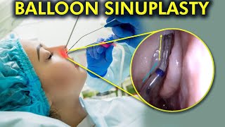 The Balloon Sinuplasty Breakthrough A Painless Path to Clear Sinuses 3d animation [upl. by Stanhope]