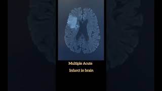 Multiple Acute infarct in Brain [upl. by Sonitnatsnok861]