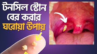 ঘরে বসে টনসিল স্টোন বের করার নিরাপদ উপায়  Tonsil Stone Treatment  Dr Muntasir Mahbub [upl. by Brand]