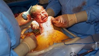 Csection Cesarean Delivery [upl. by Hole]