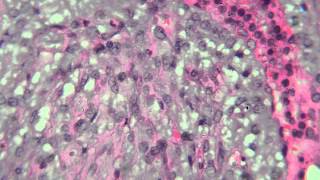 04 Phyllodes Tumor [upl. by Nader642]