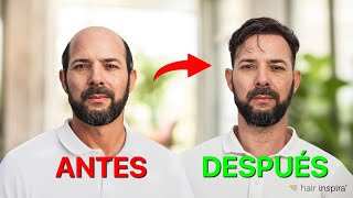 APLICACIÓN PRÓTESIS CAPILAR INDETECTABLE PARA HOMBRE l ANTES Y DESPUÉS  HAIR INSPIRA [upl. by Anaet]