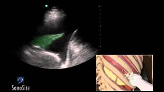 Catheterization and Stent procedure at Mercys Oklahoma Heart Hospital [upl. by Stevana335]