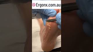 Foot callus cutting is satisfying to watch [upl. by Eidassac]