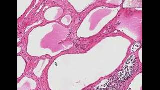 Histopathology NeckLymphangioma cystic hygroma [upl. by Dallman]