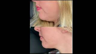 Double Chin Fat Dissolving with Ceccarelli Solution fatdissolving doublechin [upl. by Rudolf902]