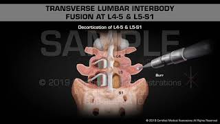 Transverse Lumbar Interbody Fusion at L45 amp L5S1  Medical Animation [upl. by Enilkcaj947]