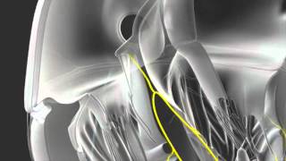 AVNRT ABLATION wwwhamilyoncom  tachycardia [upl. by Nerin806]