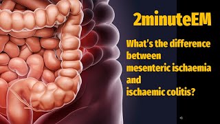 Whats the difference between mesenteric ischaemia and ischaemic colitis [upl. by Anaeerb]