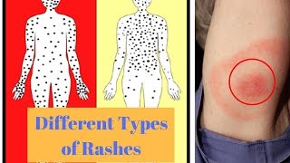 Different Types of Rashes [upl. by Lleder]