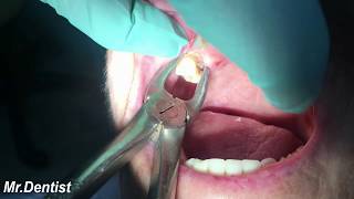 Extraction Of Molar Tooth [upl. by Akemor]