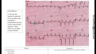 شرح ECG دمحمود سويلم [upl. by Bannasch]