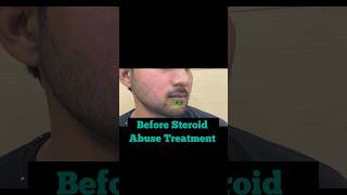 Steroid abuse Treatment  say no to steroids  Dermatologist in Punjab  Dr Ashima Goel skincare [upl. by Reema692]