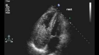 Carcinoid wPositive Bubble [upl. by Debarath]