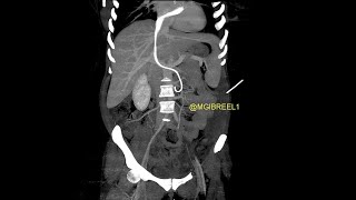 Intracardiac migration of ureteral doubleJ stent till the PV level [upl. by Dorehs480]