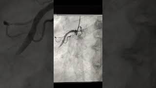 Angioplasty to LAD and CTO RCA with whisper ptca wire [upl. by Gaston493]