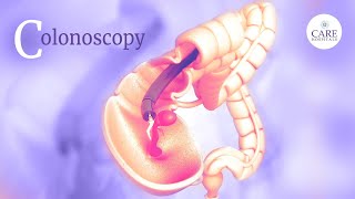 What Happens During and After a Colonoscopy  How to Prepare for a Colonoscopy [upl. by Olegnaleahcim]