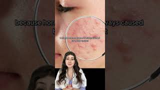 Best Way To Cure Hormonal Acne Hormonal Acne Remedies acne shorts [upl. by Platas]