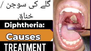 What is Diphtheria Causes of diphtheria sign and symptoms  treatment for diphtheria in Hindi [upl. by Shulem]