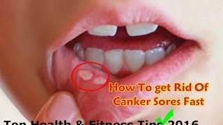 How to Get Rid Of Canker Sores in Mouth and Tongue Home Remedies [upl. by Kinson]