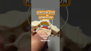 Cervical Disc Herniation Rupture of Cervical Disc Model [upl. by Andreas]