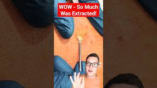 BEST BLACKHEAD REMOVAL 2023  Crazy Satisfying Extraction shorts [upl. by Edward]