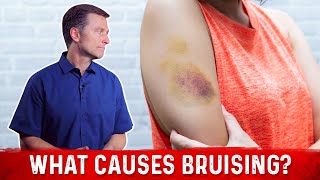 What Causes Bruising Without Trauma – Dr Berg [upl. by Doyle971]