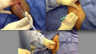 Chest Tube Placement [upl. by Eselahc558]