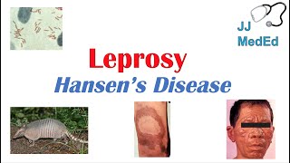 Leprosy Hansens disease  Who is at risk Signs and Symptoms Diagnosis and Treatment [upl. by Rocca]