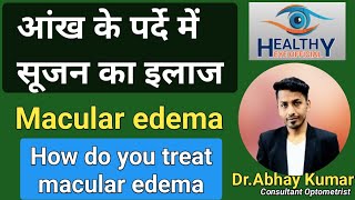 पर्दे में सूजन का इलाज  macular edema treatment  diabetic macular edema  healthyeyeofficial [upl. by Reinwald]