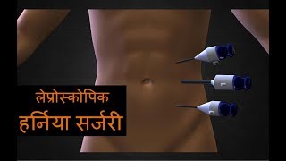 लैप्रोस्कोपिक अम्बिलिकल हर्निया सर्जरी Best Laparoscopic Incisional or Umbilical Hernia In India [upl. by Bathelda926]