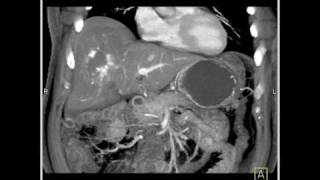 Abdomen Liver CT demonstrates a hemangioma of the liver because of the fatty infiltration8 of 10 [upl. by Chelsea]