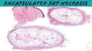 Posttraumatic fat necrosis encapsulated subcutaneous fat necrosis pathology dermpath dermatology [upl. by Pickens862]