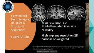 Neuroimagen en epilepsia  Dra Guadamuz [upl. by Ayardna]