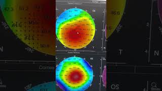 Contact Lenses  Keratoconus  Corneal  Reform Vision  Scleral Contact Lens [upl. by Adyht729]