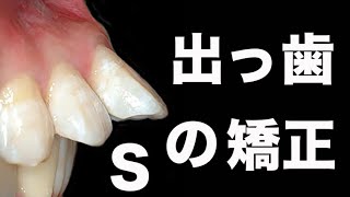 ２２才 大学生 出っ歯とゴボ口から復活した歯列矯正 410日 buck teeth GVBDO Before amp After Braces Time Lapse 410 Days [upl. by Iglesias]